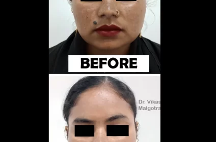 Dermatologist Vikas Malgotra in Udhampur offers expert skin, hair, and nail care with advanced, safe, and effective treatment.